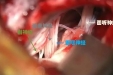 【特色技术】神经外科二病区成功开展手术治疗顽固性舌咽神经痛
