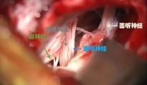 【特色技术】神经外科二病区成功开展手术治疗顽固性舌咽神经痛