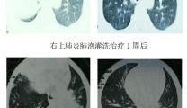 【特色技术】儿童支气管镜技术