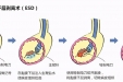 【特色技术】ESD手术-内镜黏膜下剥离术