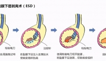 【特色技术】ESD手术-内镜黏膜下剥离术