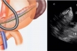 【特色技术】超声内镜检查技术