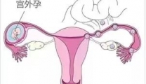 【典型病例】潍坊市益都中心医院成功救治双侧输卵管妊娠患者