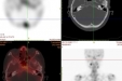 【健康科普】核医学SPECT/CT骨扫描-让骨转移病灶无处可藏