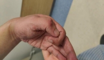 【技术突破】左右神经互换，一侧大脑管双手——潍坊市益都中心医院成功开展健侧颈7神经移位治疗上肢中枢性瘫痪手术