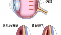【特色技术】眼底病组医师团队助您解除眼底“危机”——黄斑裂孔手术