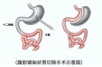 【特色技术】胃肠外科：“袖”出自信，“胃”来可期——腹腔镜下袖状胃切除术