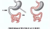 【特色技术】胃肠外科：“袖”出自信，“胃”来可期——腹腔镜下袖状胃切除术