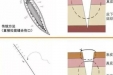 【健康科普】让美丽“不留痕”——美容缝合技术在医学美容中的应用