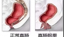 【特色技术】结直肠肛门外科：为您解决直肠脱垂之苦——Altemeier术
