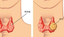 【特色技术】夯实“针”功夫，练就硬本领——超声引导下甲状腺结节穿刺活检技术