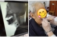 【特色技术】神经康复科：导管球囊扩张术帮您摆脱吞咽障碍