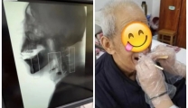 【特色技术】神经康复科：导管球囊扩张术帮您摆脱吞咽障碍