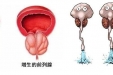 【特色技术】泌尿外科经尿道等离子电切术治疗——前列腺增生的微创治疗