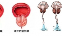 【特色技术】泌尿外科经尿道等离子电切术治疗——前列腺增生的微创治疗