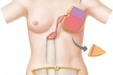 【技术突破】腹直肌肌皮瓣乳房重建术 助力重塑美丽人生
