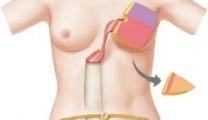 【技术突破】腹直肌肌皮瓣乳房重建术 助力重塑美丽人生