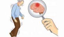【健康科普】帕金森病的早期识别与科学诊断