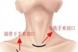 【技术突破】潍坊市益都中心医院成功实施经锁骨下入路腔镜下甲状腺癌根治术