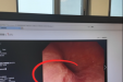 第三十二期：胃食管反流微创治疗手段——内镜下贲门紧缩治疗，短期内恢复正常饮食，反酸、烧心症状消除